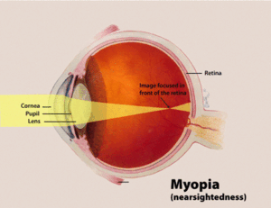 Myopia Treatment Mercerville NJ