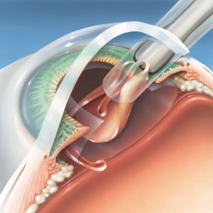 Cataract Surgery in Monmouth County NJ 